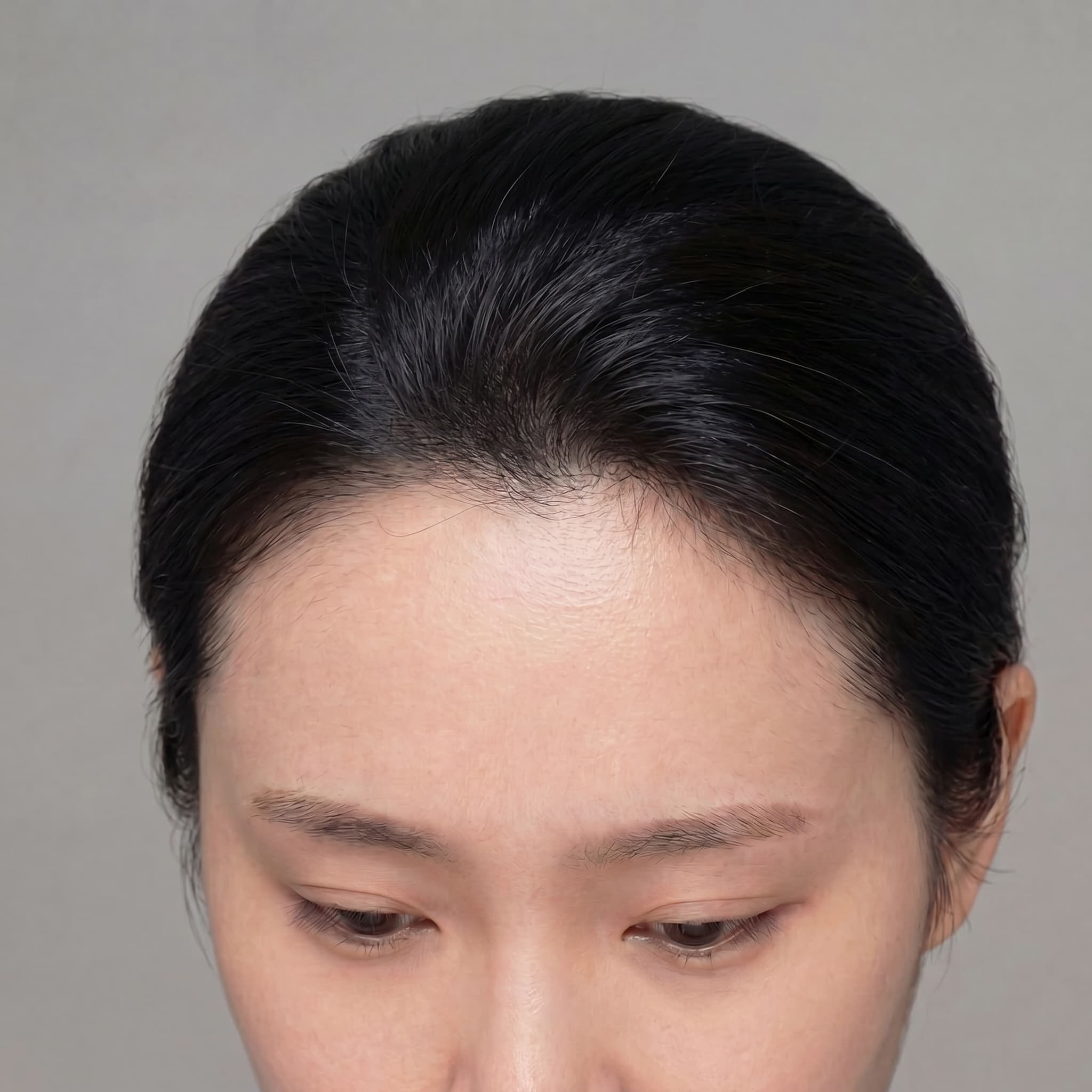 Zero Damage High-Density Slit Transplant