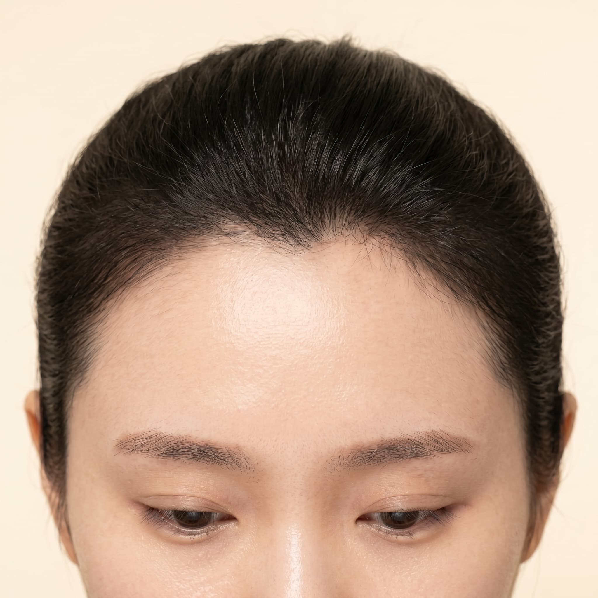 PDRN 모낭 재생